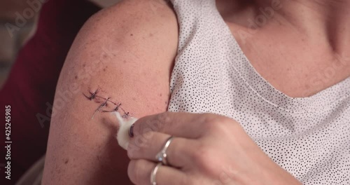 A woman is medicating an arm's sutured wound at home