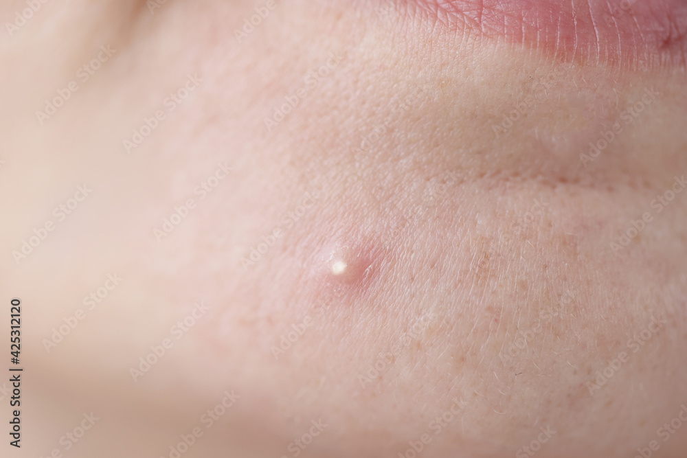 White red pimple on skin of face