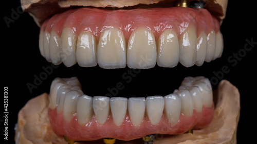 dental prostheses of the upper and lower jaws made of titanium and ceramic, with a pink gum in the open state on a black background