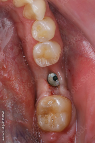 healed gums in the area of the chewing tooth and dental shaper for preparing prosthetics