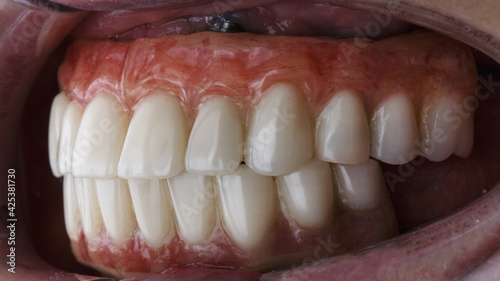 temporary dentures for the entire jaw in the patient's mouth after implantation
