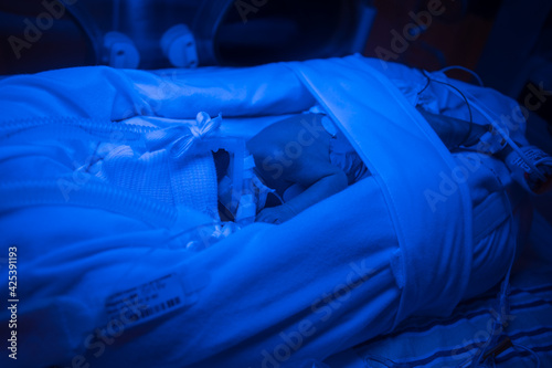 Premature baby under blue light, receiving phototherapy UV treatment