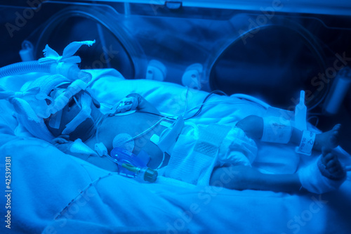 Premature baby under blue light, receiving phototherapy UV treatment