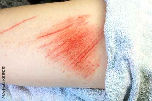 A Large Skin Abrasion To The Upper Part Of A Leg. photo