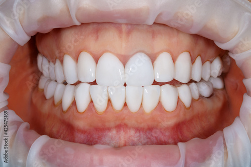 Dental of teeth close up. Teeth whitening image. Bleach veneers. Dental photography
