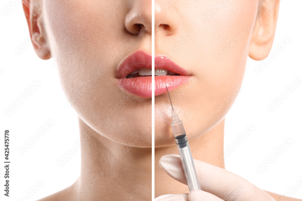 © Pixel-Shot - Young woman before and after lips enhancement, closeup