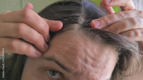 Seborrheic skin rash on  s head, seborrheic dermatitis, close-up, healthcare, medicine. Itching On The Scalp. Scalp disease treatment concept. Discomfort from a fungal infection