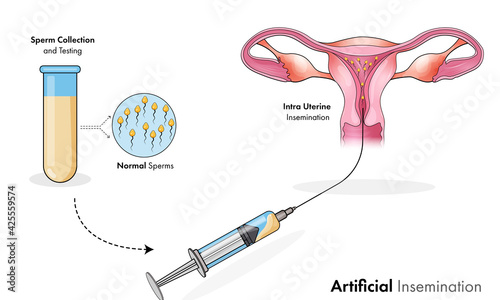 human anatomy: artificial insemination for women pregnancy.   photo