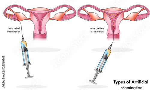 Types of artificial insemination: intra uterine and intra tubal mode for women pregnancy . 