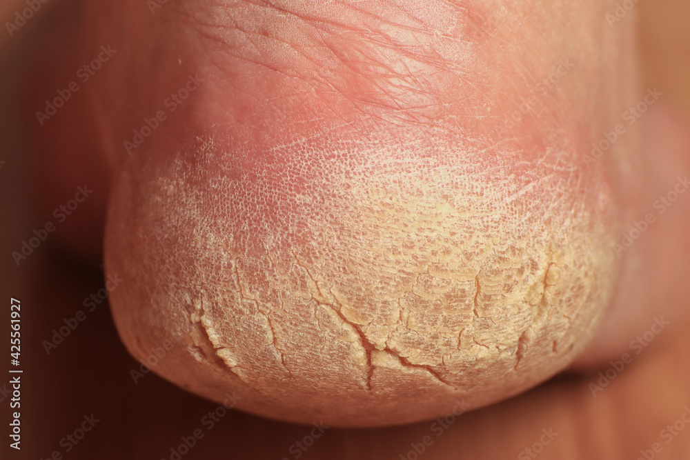 Fototapeta premium Close-up of a man's cracked heel. Problem area of the foot requiring medical and cosmetic treatment. Rough yellowed dry skin dies off in parts.