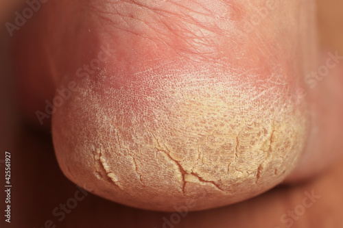 Close-up of a man's cracked heel. Problem area of the foot requiring medical and cosmetic treatment. Rough yellowed dry skin dies off in parts.