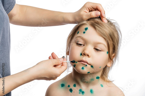 Εκτύπωση καμβά A seven year old girl suffers from an infectious disease of chickenpox, her pimples are smeared with brilliant green