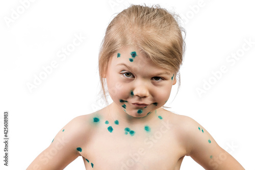 A seven year old girl suffers from an infectious disease of chickenpox, her pimples are smeared with brilliant green.