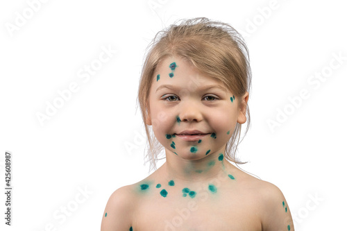 Φωτογραφία A seven year old girl suffers from an infectious disease of chickenpox, her pimples are smeared with brilliant green
