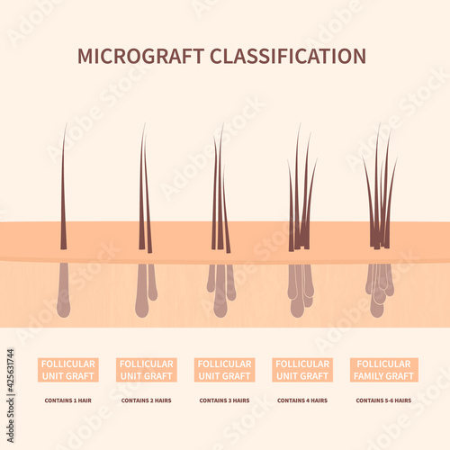 Hair micrograft classification set for hair transplantation surgery. Skin cross-section with number of hairs in the follicular unit or family. Hair science and anatomy. Cartoon vector illustration.