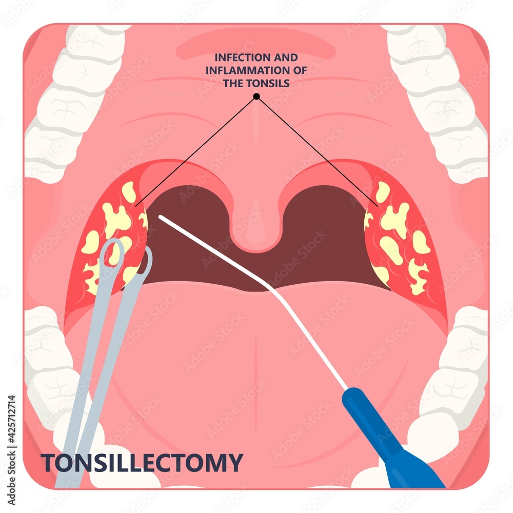 Tonsil Stones crypts viral virus gland strep throat sore enlarged lymph