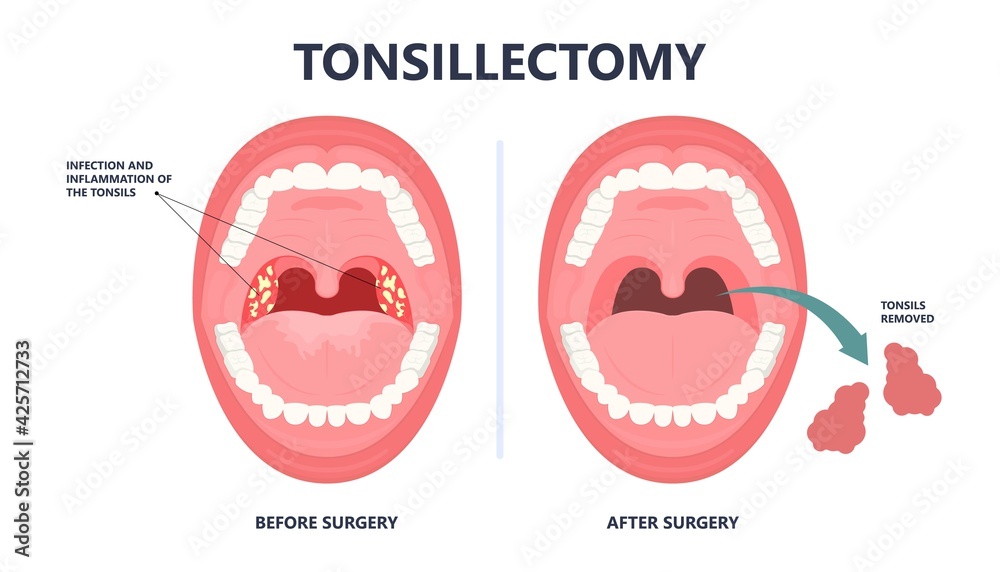 Vetor Do Stock Tonsil Stones Crypts Viral Virus Gland Strep Throat