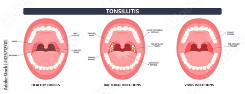 Tonsil Stones crypts viral virus gland strep throat sore enlarged lymph nodes neck pain swollen pus white mouth bacteria Herpes simplex HSV cold fever Epstein Barr fetid bad odor oral laser aureus photo