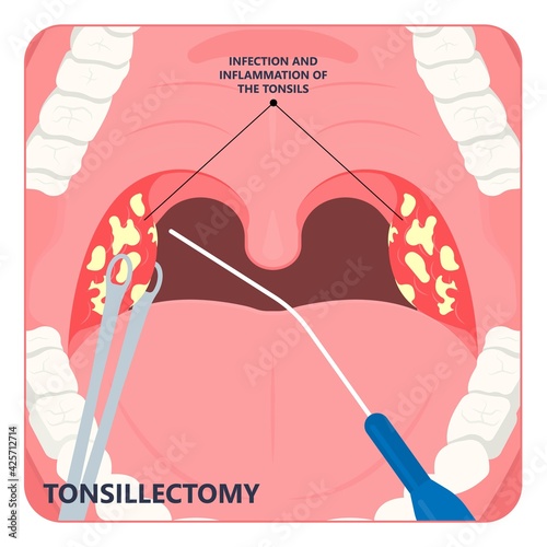 Tonsil Stones crypts viral virus gland strep throat sore enlarged lymph nodes neck pain swollen pus white mouth bacteria Herpes simplex HSV cold fever Epstein Barr fetid bad odor oral laser aureus