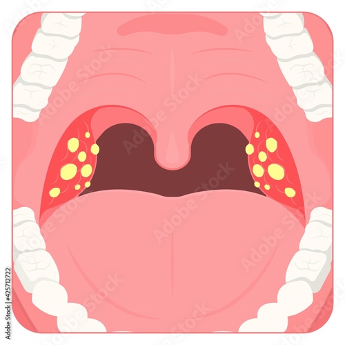 Tonsil Stones crypts viral virus gland strep throat sore enlarged lymph nodes neck pain swollen pus white mouth bacteria Herpes simplex HSV cold fever Epstein Barr fetid bad odor oral laser aureus