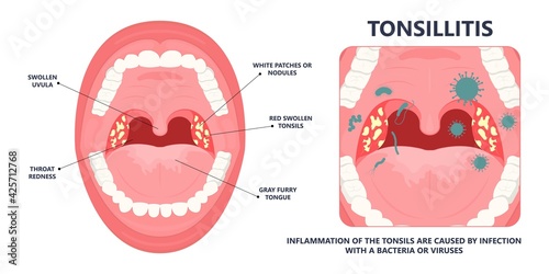 Tonsil Stones crypts viral virus gland strep throat sore enlarged lymph nodes neck pain swollen pus white mouth bacteria Herpes simplex HSV cold fever Epstein Barr fetid bad odor oral laser aureus
