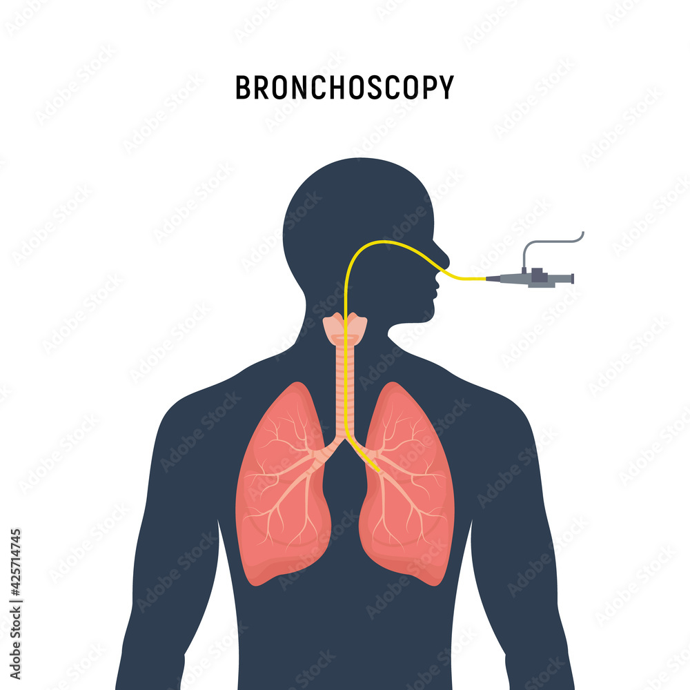 Bronchoscopy Visualization Bronchoscopy respiratory system emphysema endoscopy human lung ...