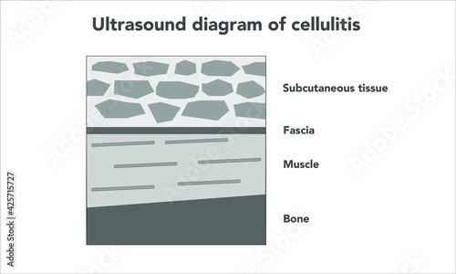 ultrasound diagram of cellulitis shows tissue edema with cobblestone pattern. healthcare and medical concept
