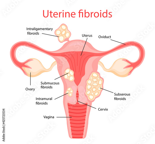 Fibroids. Diseases of the female reproductive system. Vector illustration in flat cartoon style