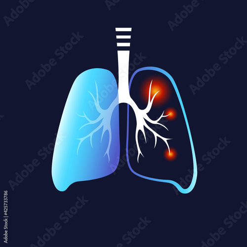 Human lungs with Inflammation and without. Covid-19 in the lungs Sars disease, coronaviruse. Causes the severe illness SARS . Neon flat style. Medicine icon for banner, infographic, template. Vector