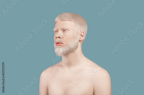 Photos Albinism concept