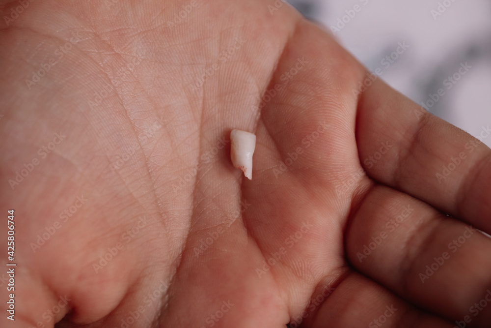 close-up the first fallen baby tooth with blood and roots, the front incisor in the palm of the doctor or mother. close-up the first fallen baby tooth with blood and roots, the front incisor in the palm of the doctor or mother.