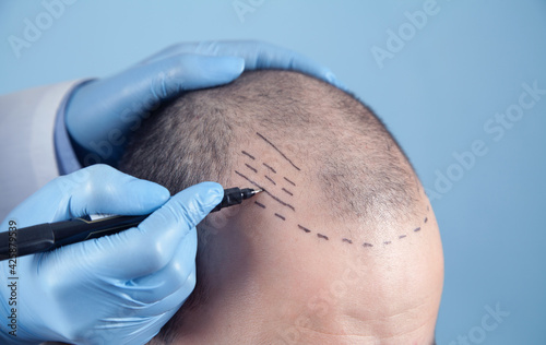 Quadro em tela Patient suffering from hair loss in consultation with a doctor