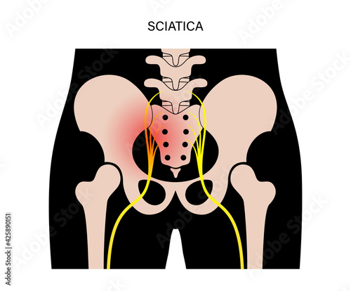 Muscular pelvis concept