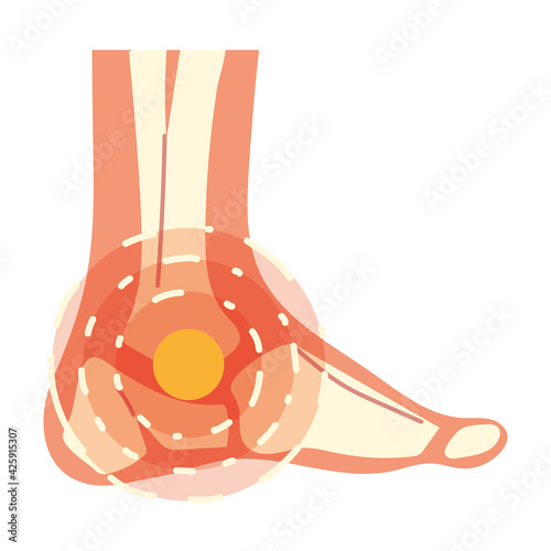 arthritis foot pain