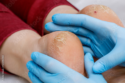 A pedicure doctor examines a patient's feet with problematic heels with cracks and dry skin. Foot treatment and care for diabetic skin.