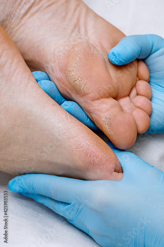 A pedicure doctor examines a patient's feet with problematic heels with cracks and dry skin. Foot treatment and care for diabetic skin.