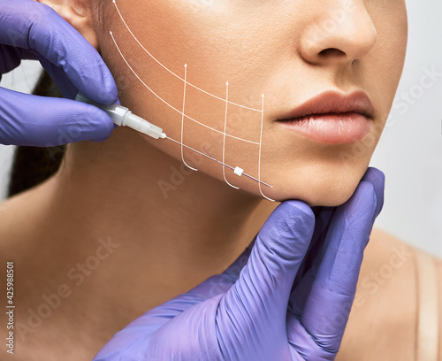 Facial lifting thread. Thread facelift with arrows on face for woman's skin, procedure facial contouring using mesothreads