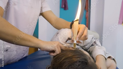 Close-up of a therapist performing an ear wax removal treatment on a patient using candling. photo
