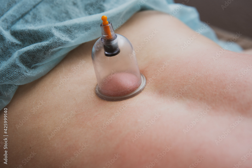 Fototapeta premium The master provides a can massage procedure. Set up cans on the back of the client. Multiple vacuum cup of medical cupping therapy can be good alternative for treatment of back pain.