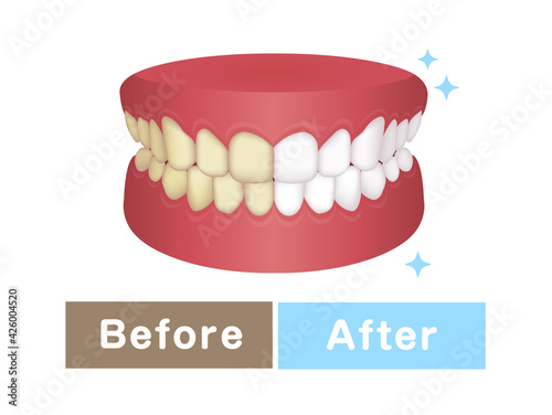 Teeth whitening vector illustration / before and after