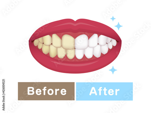 Teeth whitening vector illustration / before and after