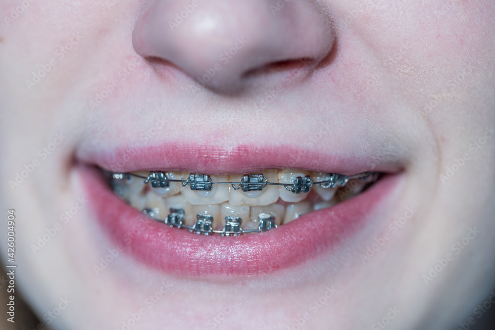 Obraz premium Cute young girl with dental braces. Girl teenager smiling