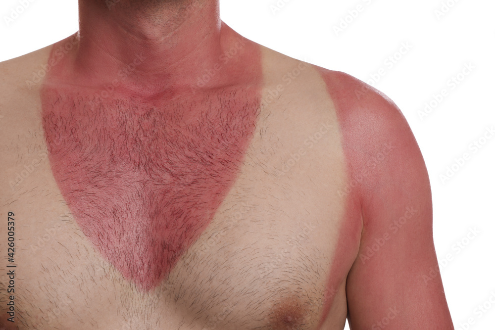 Fototapeta premium Man with sunburned skin on white background, closeup