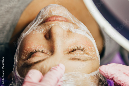 cosmetologist performs laser rejuvenation procedure. CO2 Fractional Laser