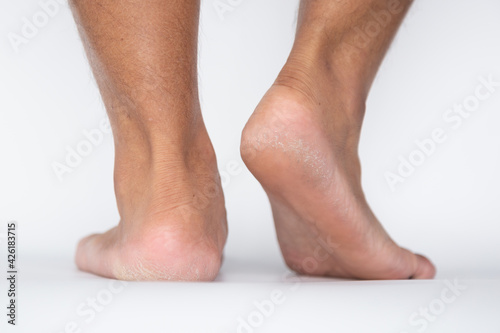 The calluses feet skin, Hard foot skin. © AP focus