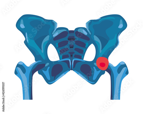 Rheumatology pelvis bones