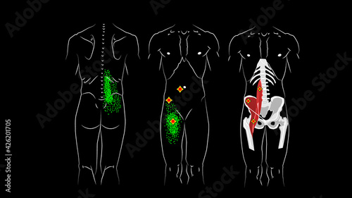 Foto Trigger points and reflected pain in psoas major muscle, psoas minor muscle and in Iliacus muscle