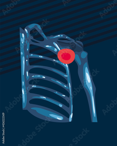 Rheumatology human ribs