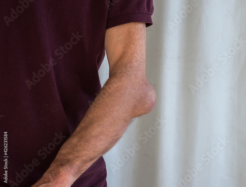 Man with elbow bursitis