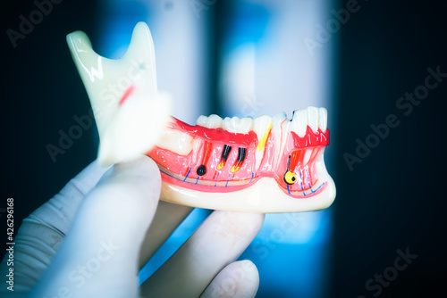 Tooth decay dental model